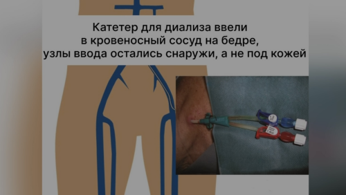 В Челнах сделали уникальную операцию, установив искусственные сосуды для очищения почек