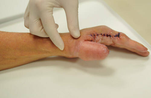 «Собрали из его же кожи и кости»: как врачи РКБ вырастили пациенту большой палец руки