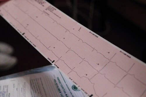 «Можно всю жизнь не подозревать о нем»: насколько страшен порок сердца и как его выявить