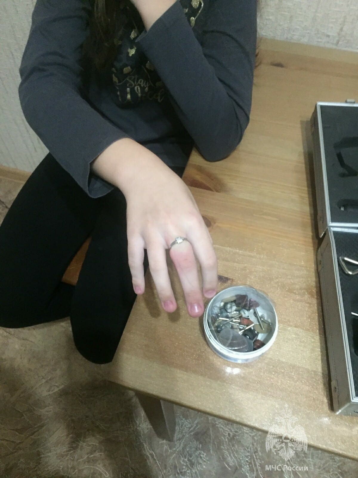В Казани спасатели помогли снять с пальца девочки застрявшее кольцо