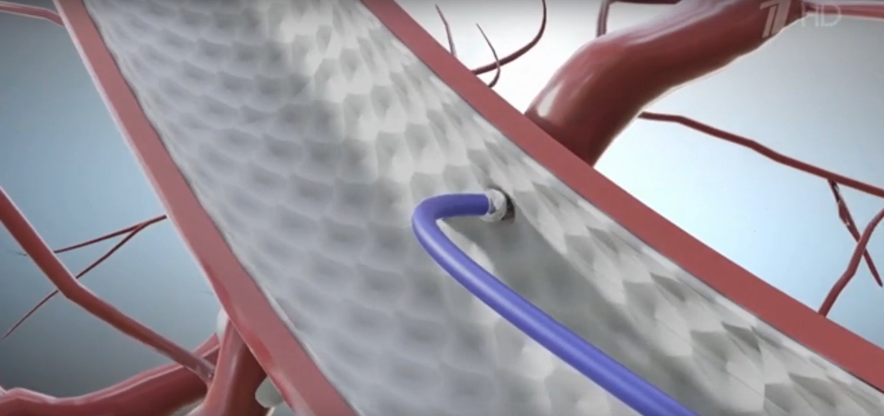 Врачи БСМП Челнов в программе Елены Малышевой рассказали о лечении расслоения аорты