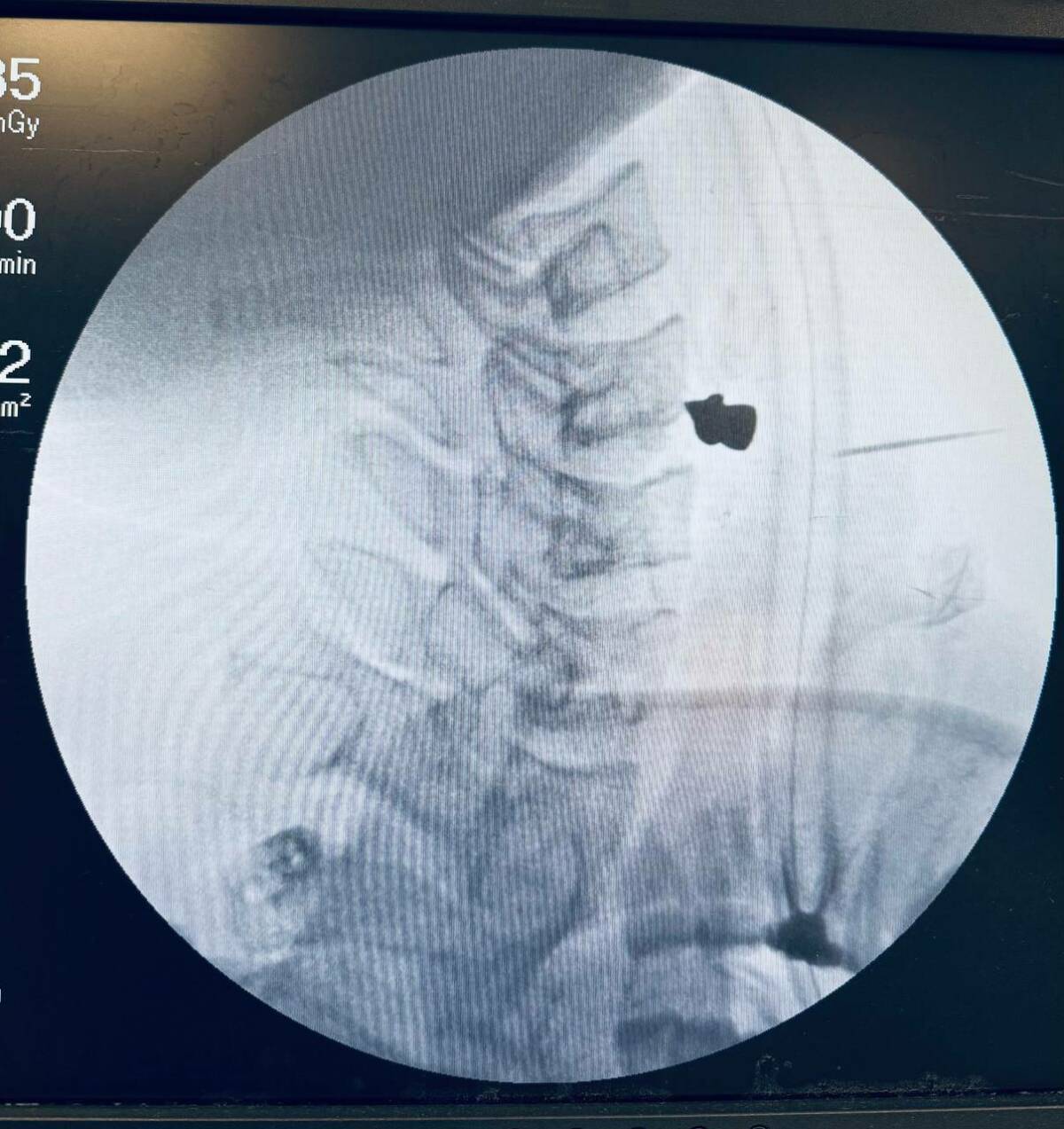 Врачи РКБ извлекли из шеи мужчины пулю, чудом не задевшую жизненно важные органы