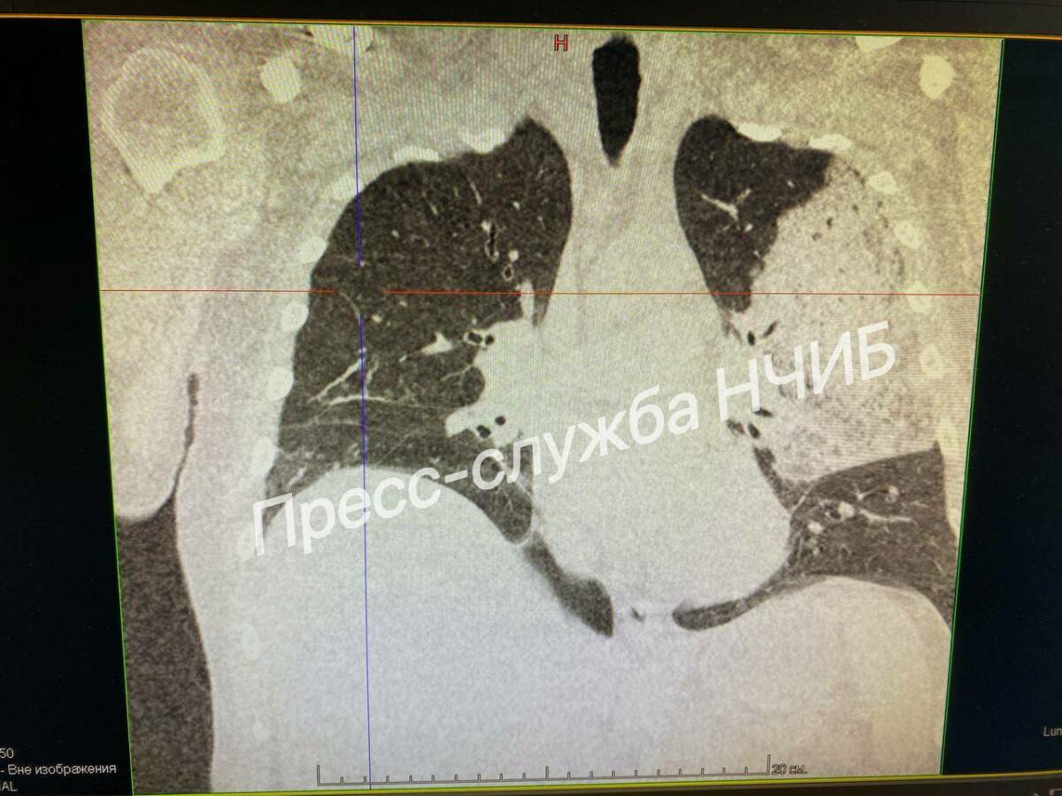 В Челнах врачи спасли мужчину, который провел десять дней на ИВЛ