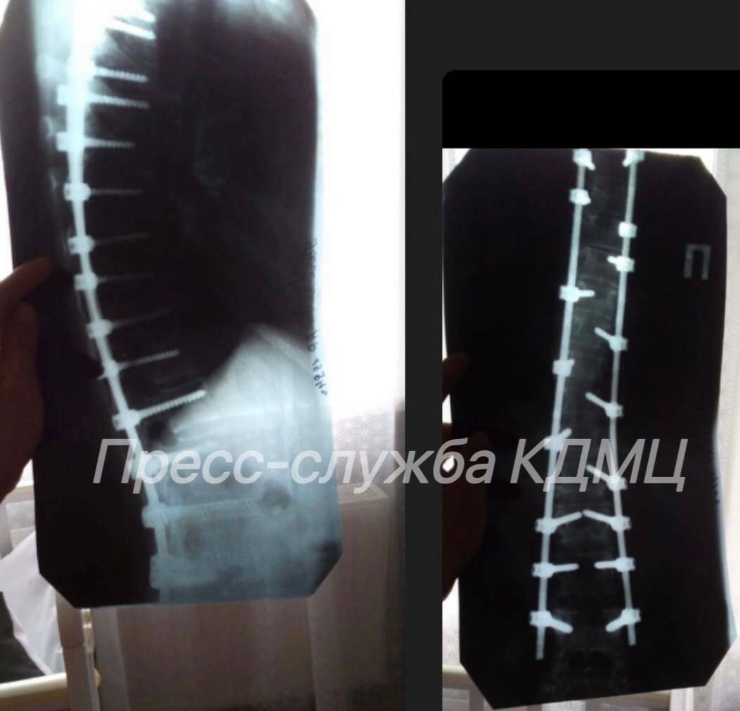 В Челнах врачи провели кесарево сечение у роженицы с металлоконструкцией в позвоночнике
