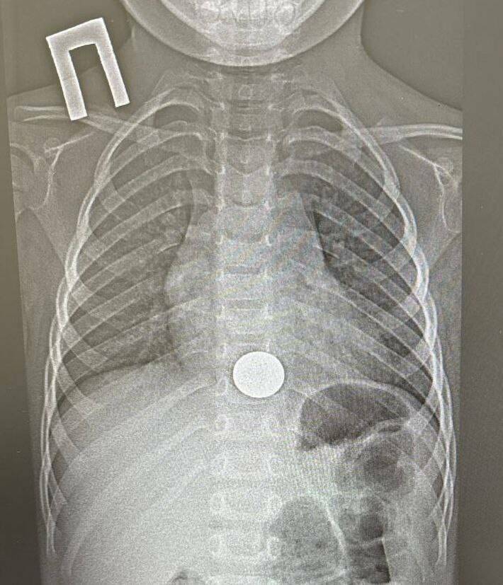 В Нижнекамске врачи спасли ребенка, проглотившего монету