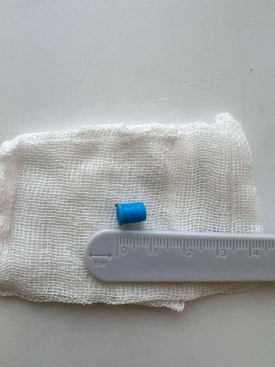 Врачи КДМЦ спасли 10-летнего челнинца, чья жизнь была под угрозой из-за колпачка от ручки