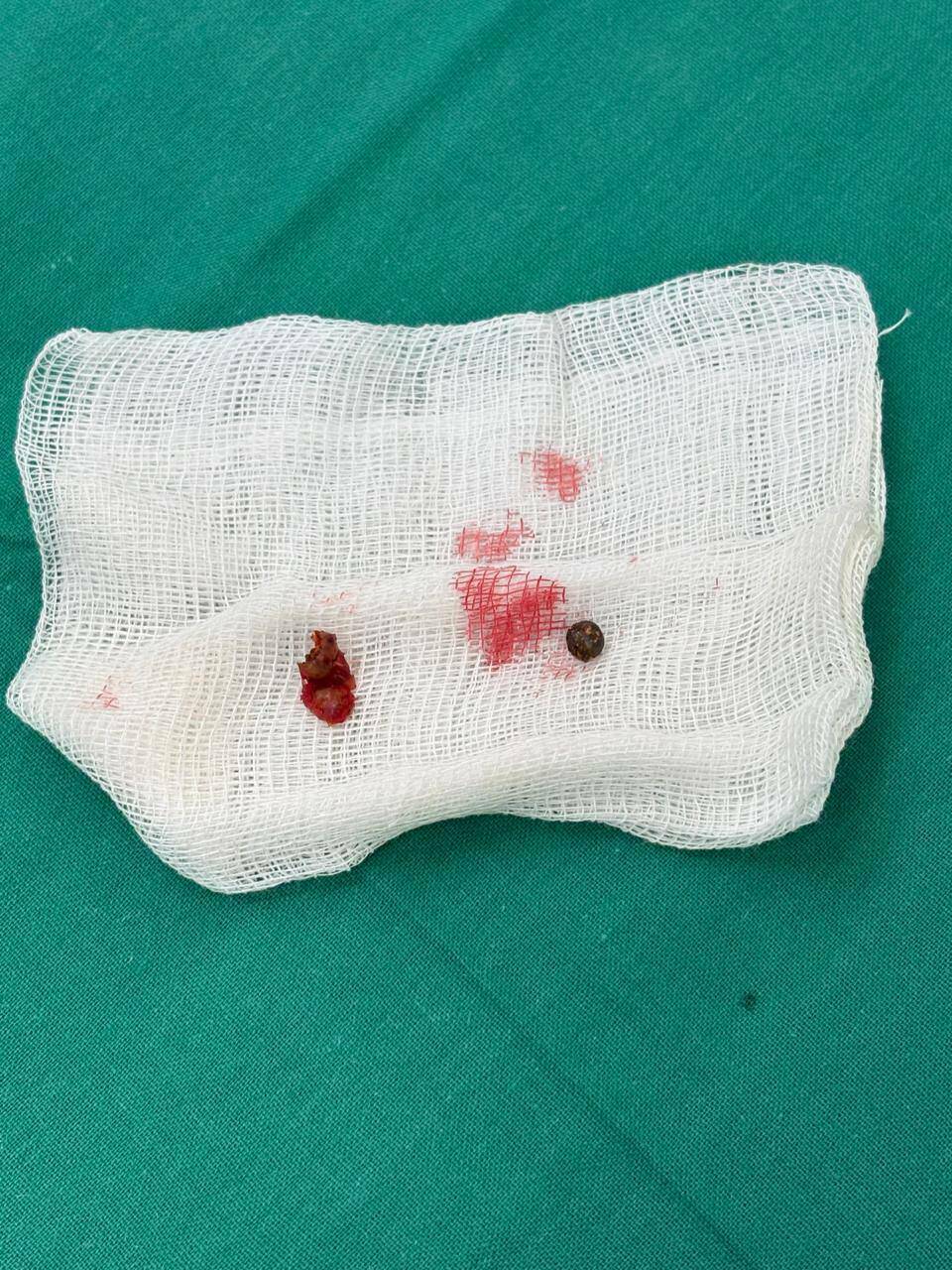 Врачи Татарстана впервые извлекли осколок из бьющегося сердца бойца СВО