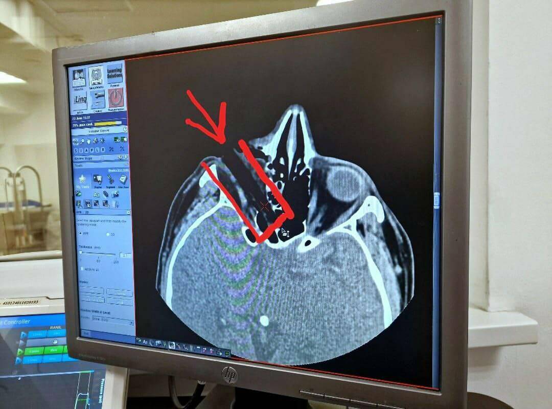 В Челнах врачи спасли зрение мужчине, в глаз которого попал 7-сантиметровый сучок